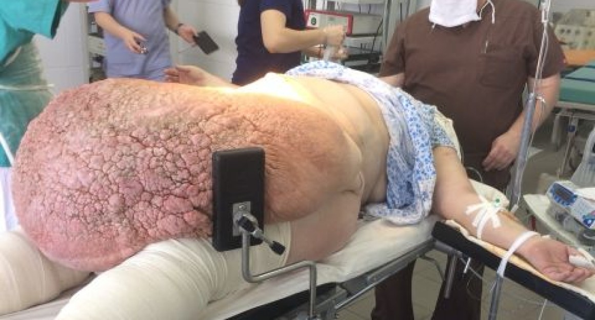 60 кг жира удалили женщине в больнице Ульяновска