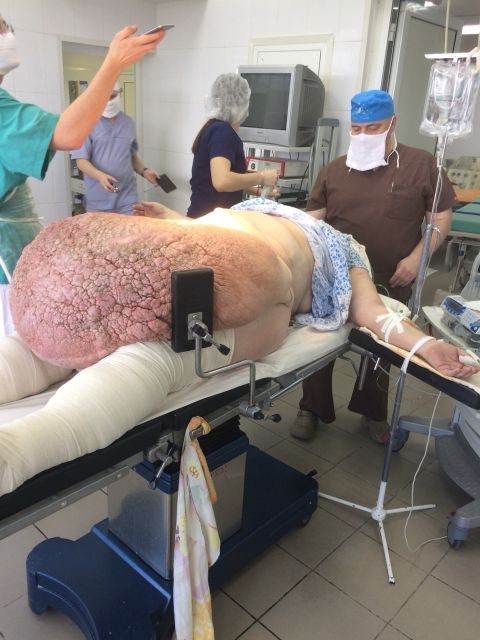 60 кг жира удалили женщине в больнице Ульяновска
